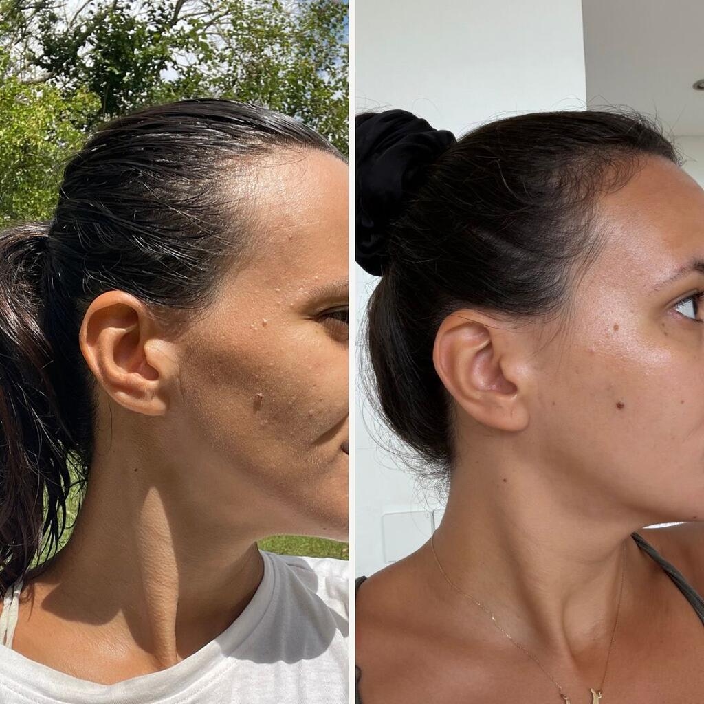 MagniGlow 1 month transformation 6