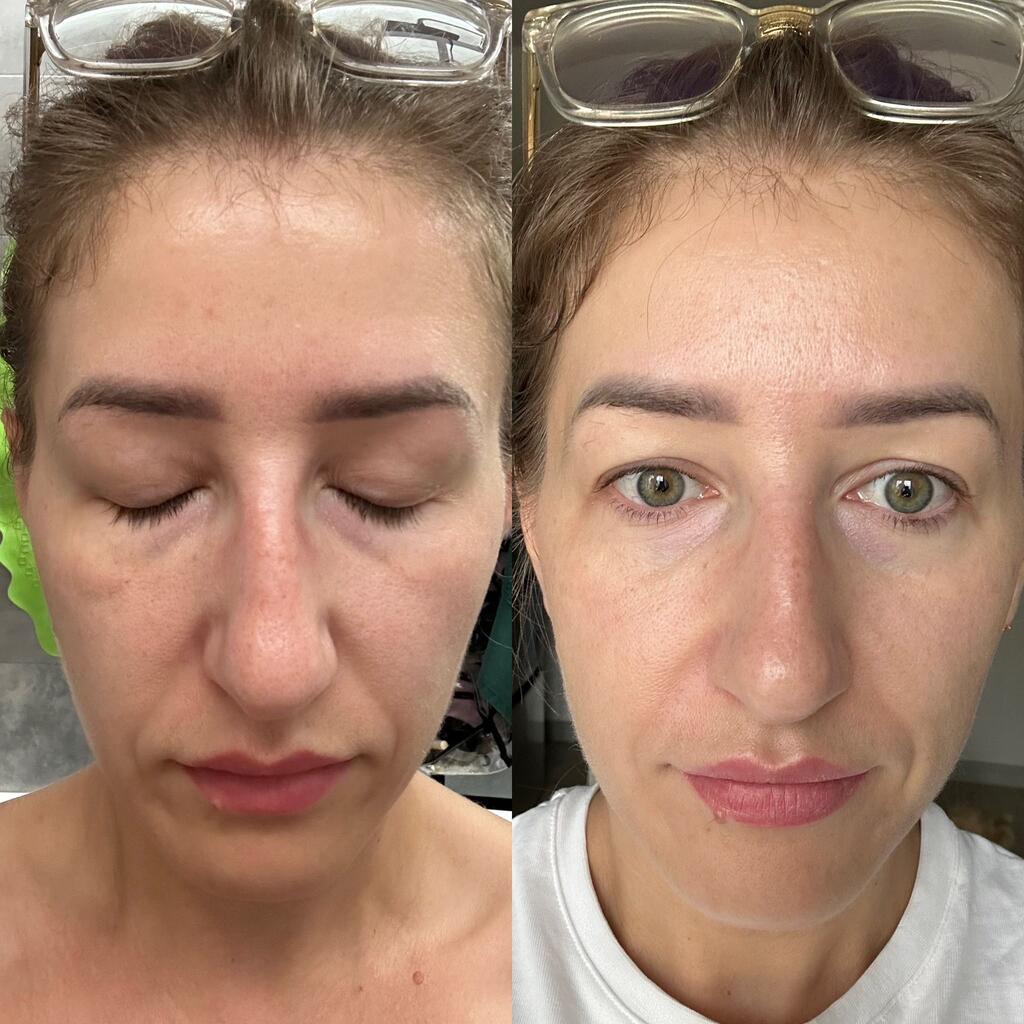 MagniGlow 1 month transformation 5