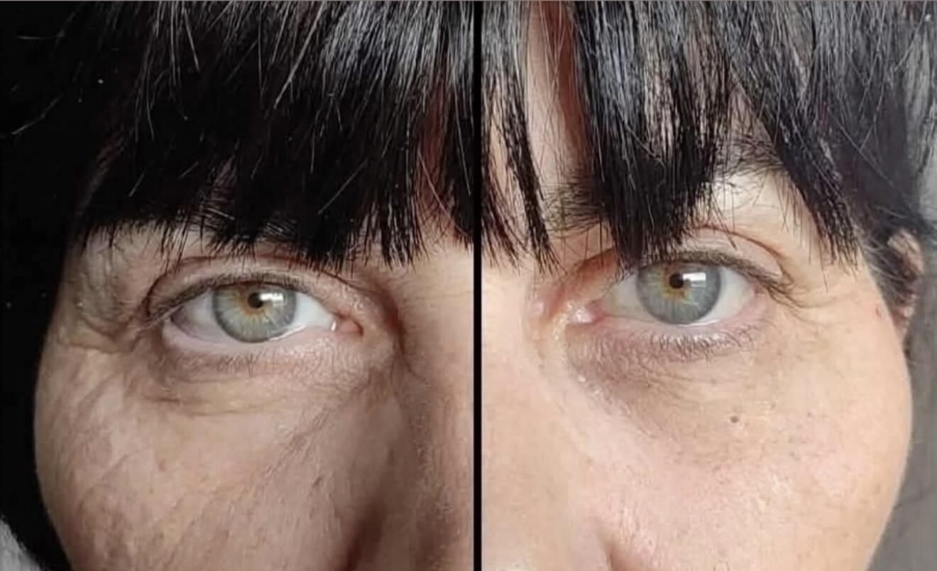 MagniGlow 1 month transformation 4