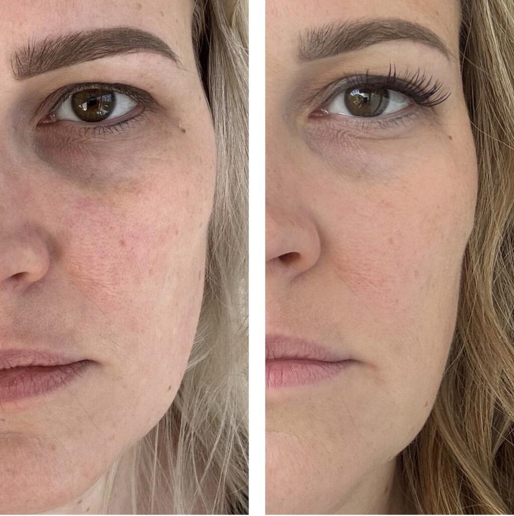 MagniGlow 3 months transformation result