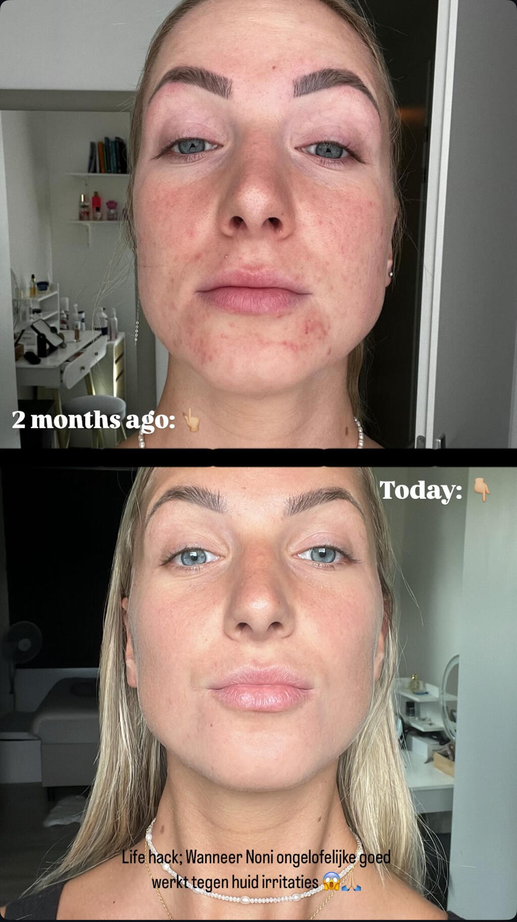 Noni and Acne Testimonial