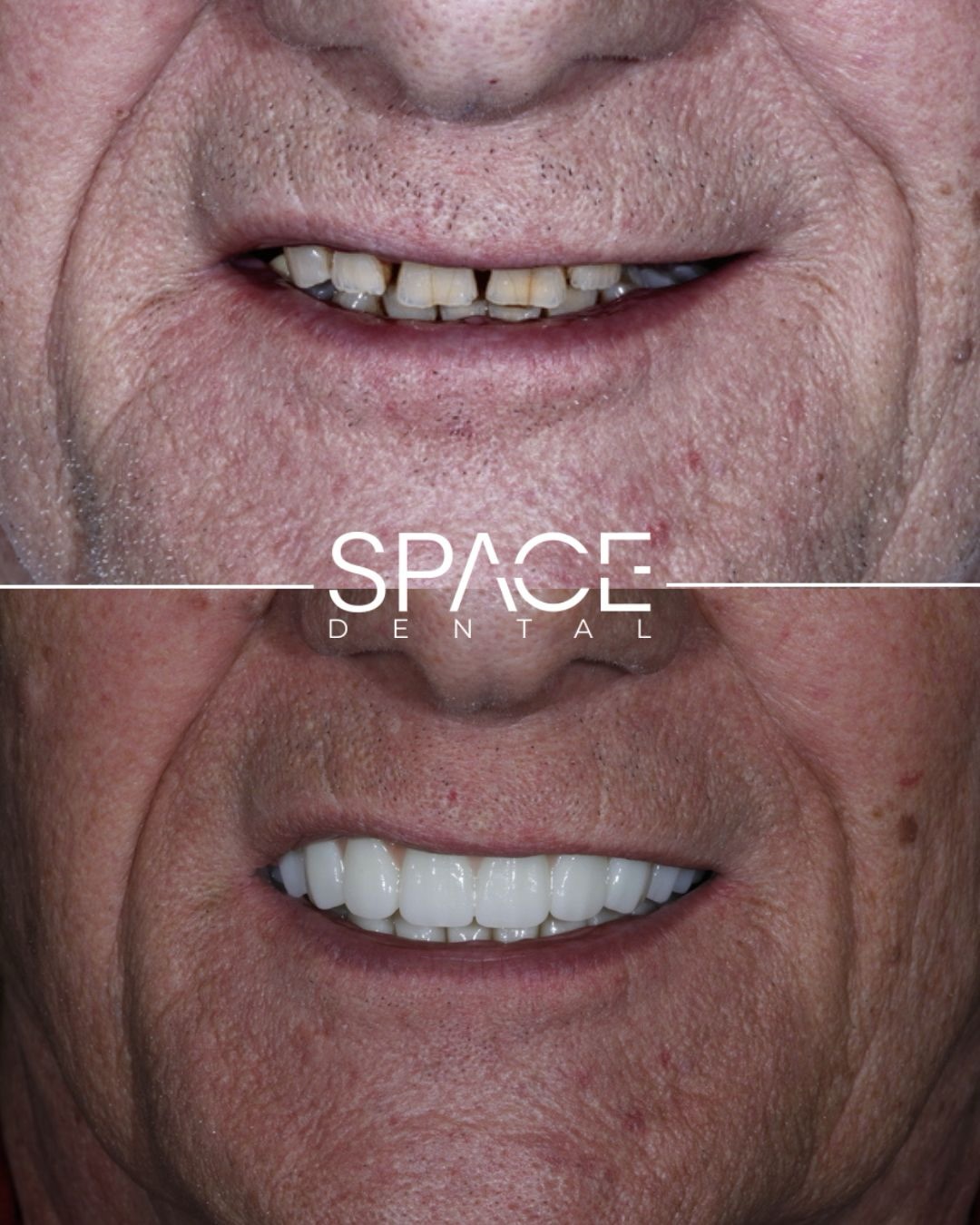 Full Arch Dental Implant Rehabilitation