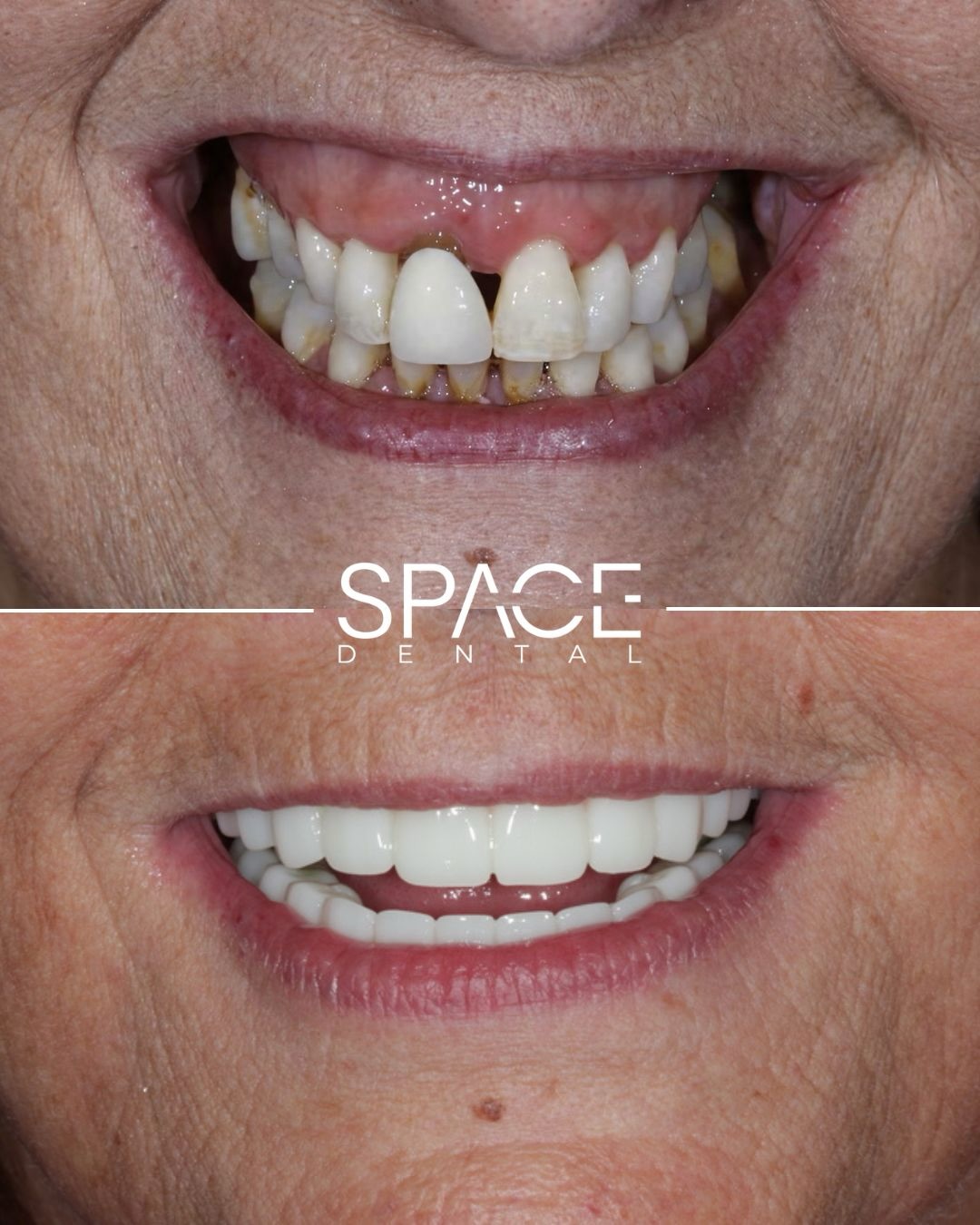 Complete Upper & Lower Implant Restoration