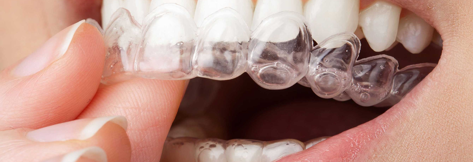 Invisalign clear aligner treatment at KDENTAL Studio