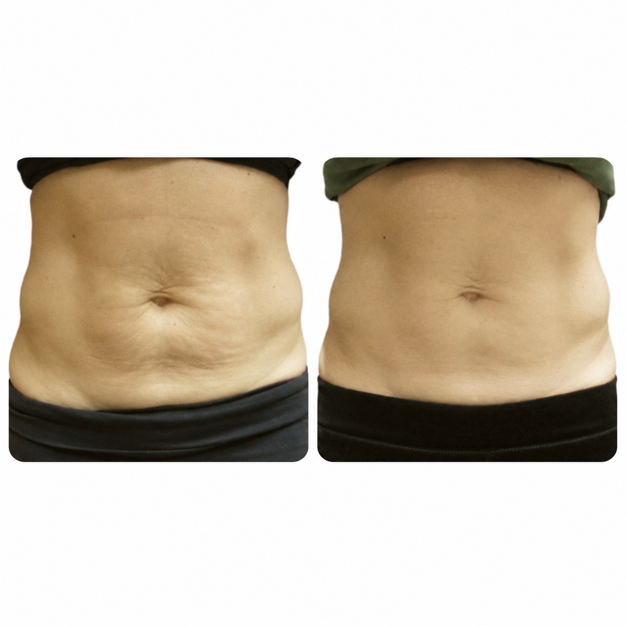 Venus Nova before and after results