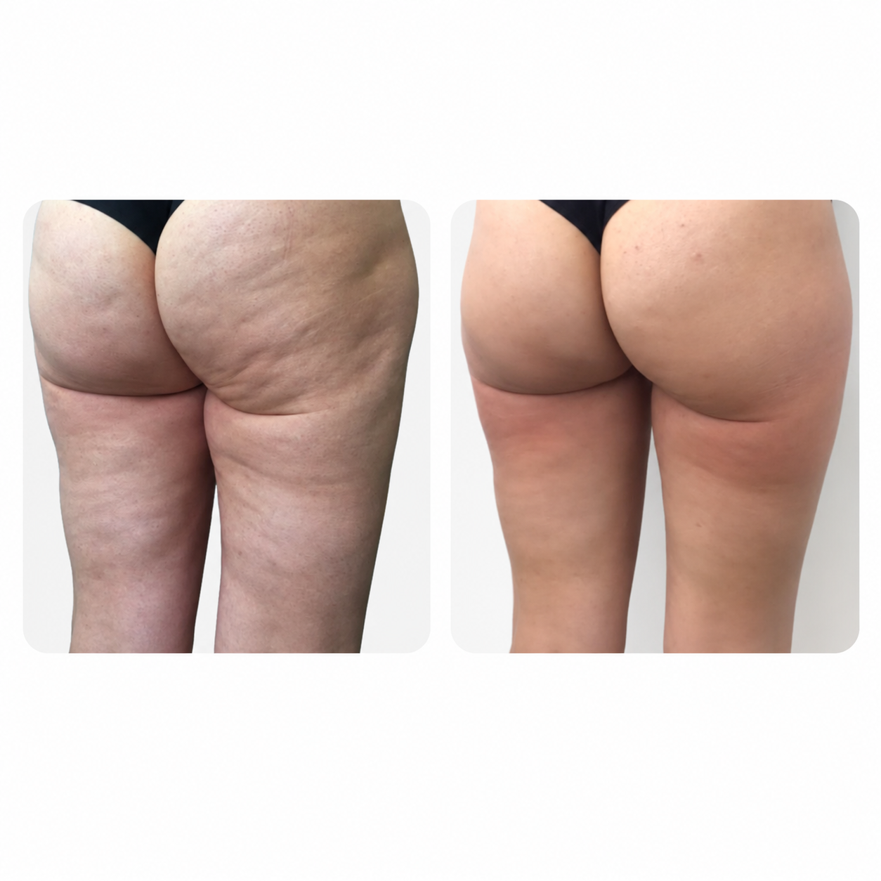 Venus Nova before and after results