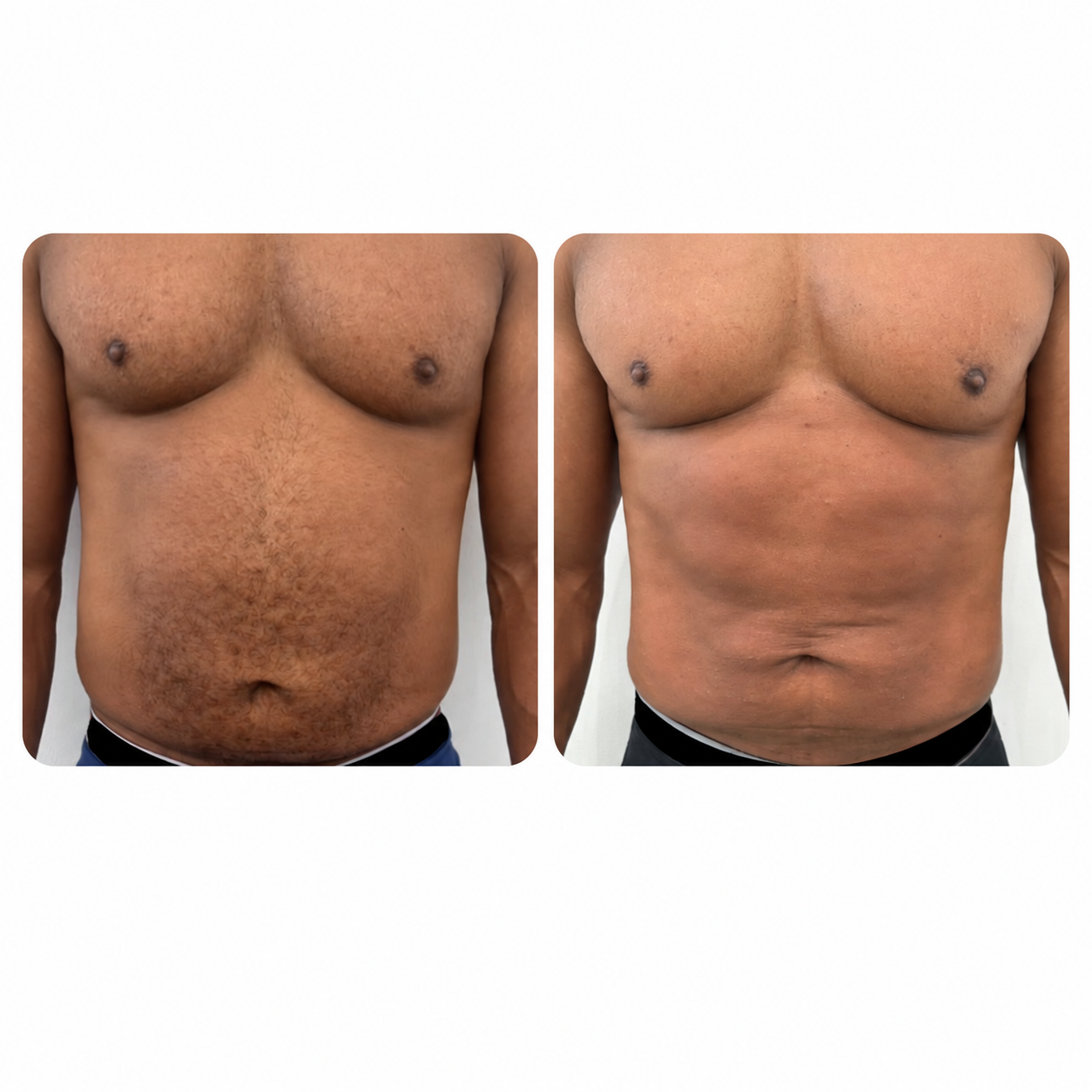 Venus Nova before and after results