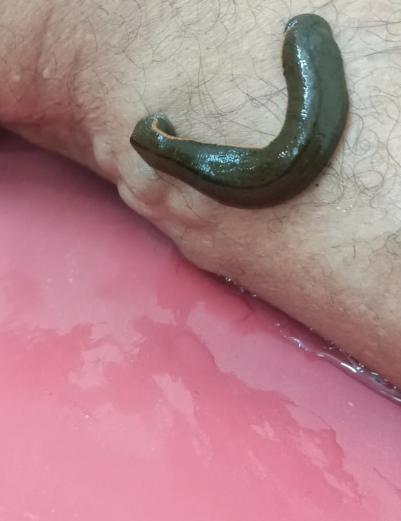 Leech Therapy for Chronic Inflammation & Wound Repair