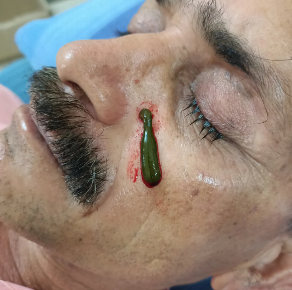 Leech Therapy (Jalaukavacharana)