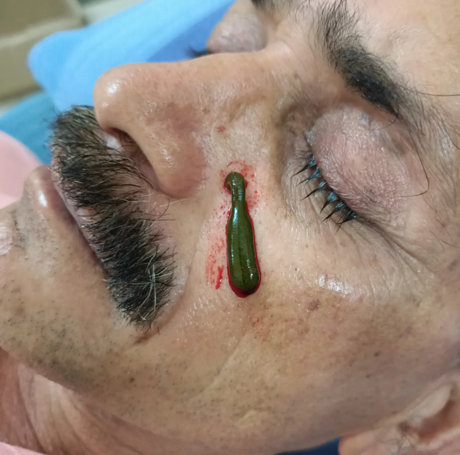 Leech Therapy for Facial & Microvascular Health