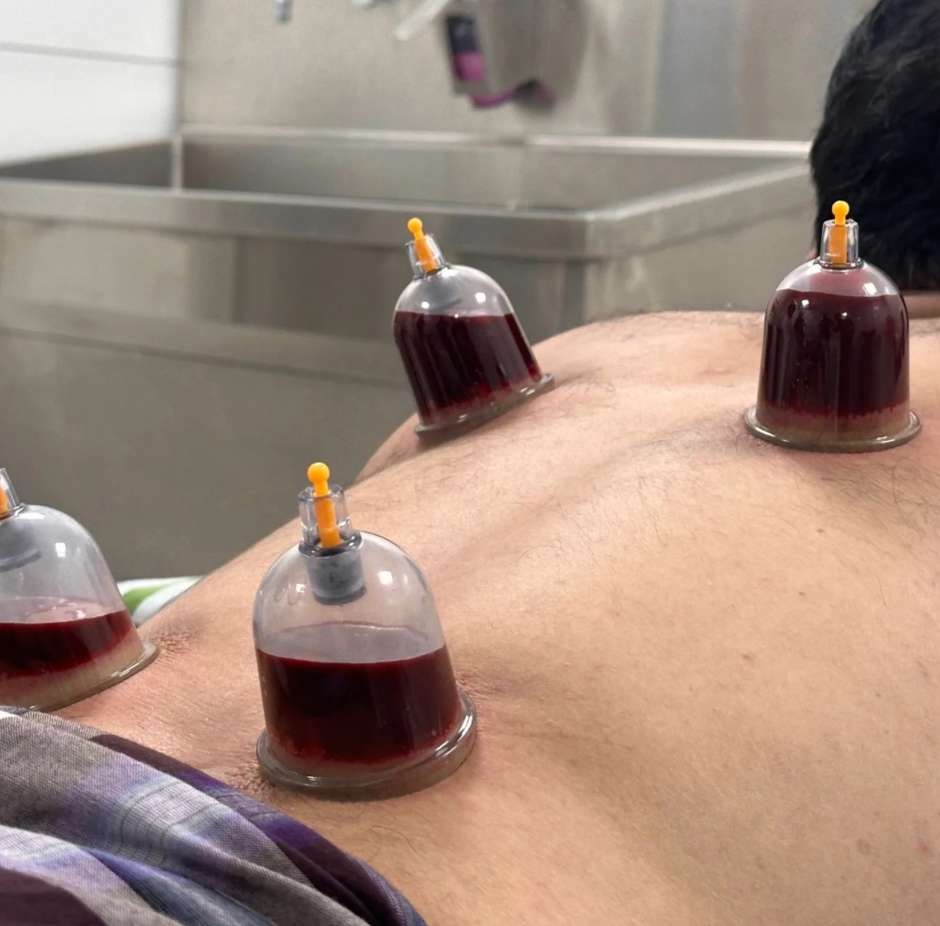 Cupping Therapy (Alabu / Wet & Dry Cupping)