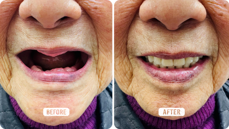 Partial Denture Natural Shade Match