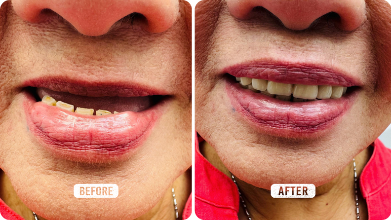 Full Denture Restorative Transformation