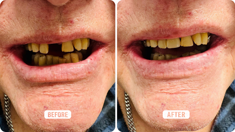 Implant Overdenture Smile Line