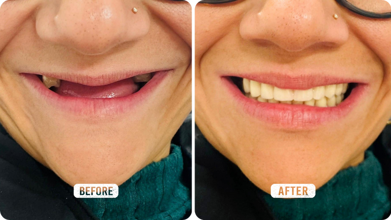 Immediate Dentures