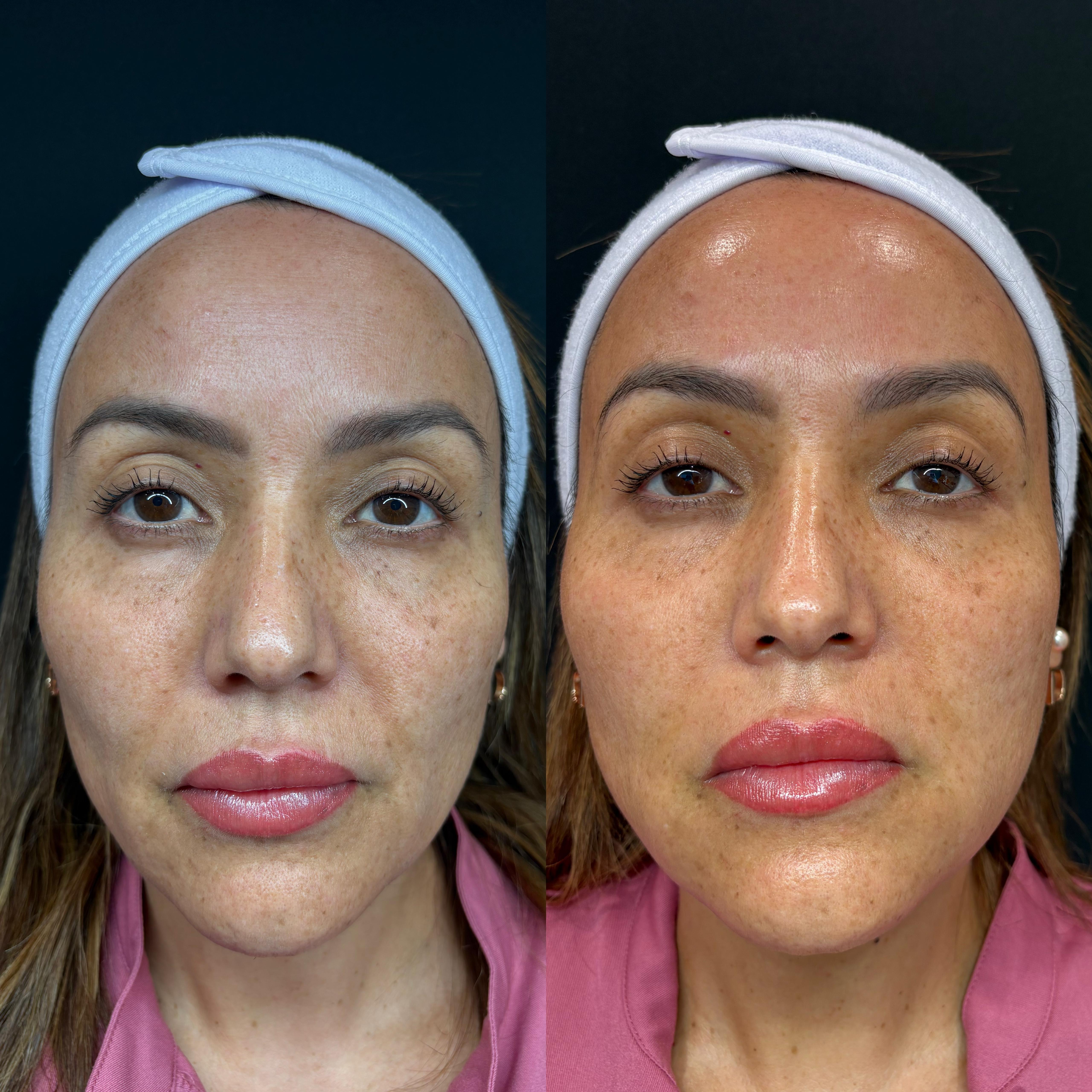Real LHALA before and after comparison of Faby showing refined texture and radiant glass-skin glow