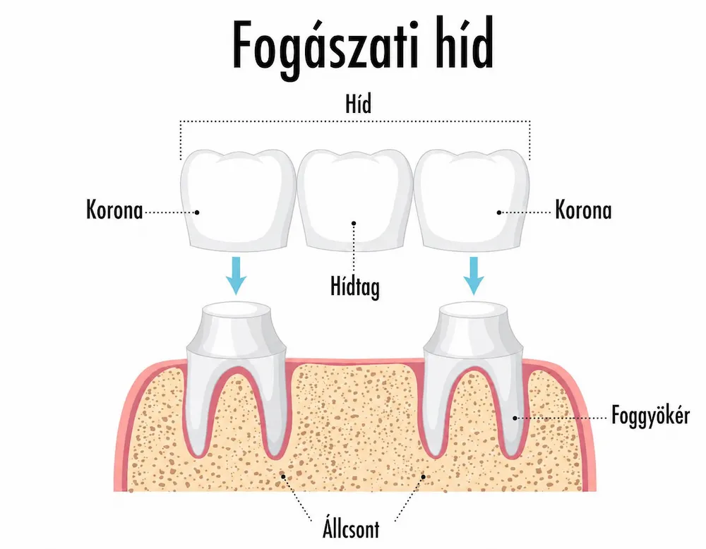 Fogkorona és híd készítése a Györe Dentnél Szegeden