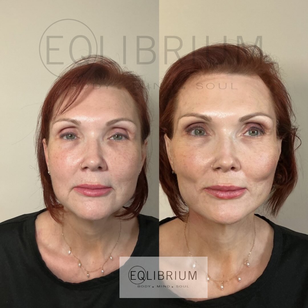 EQ lift before and after Mid-face repositioning & cheek contour