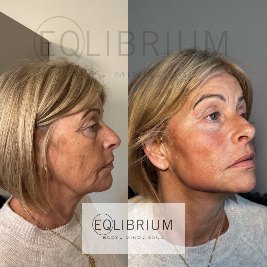 EQ lift before and after Jawline contour & lower face lift