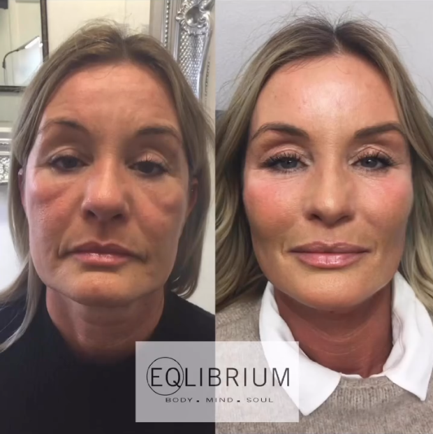 EQ lift before and after Mid-face, jowls & lower cheek lift