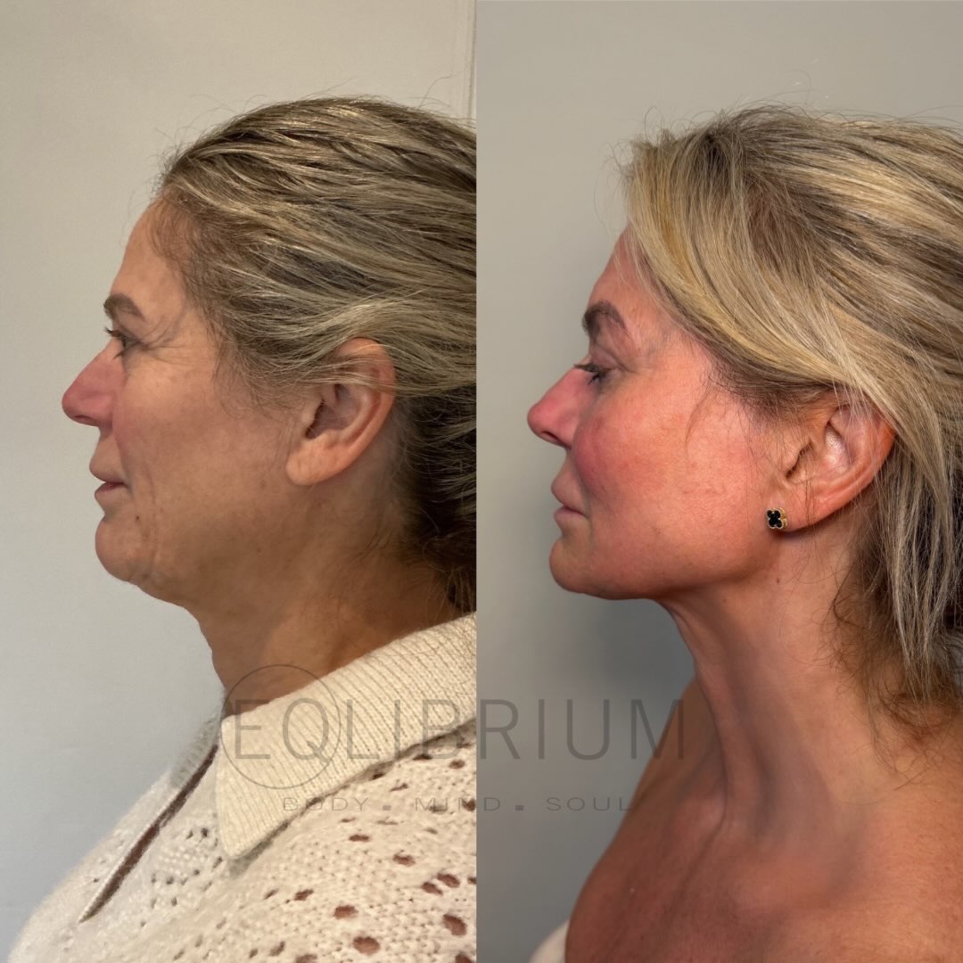 EQ lift before and after Jawline profile & neck definition