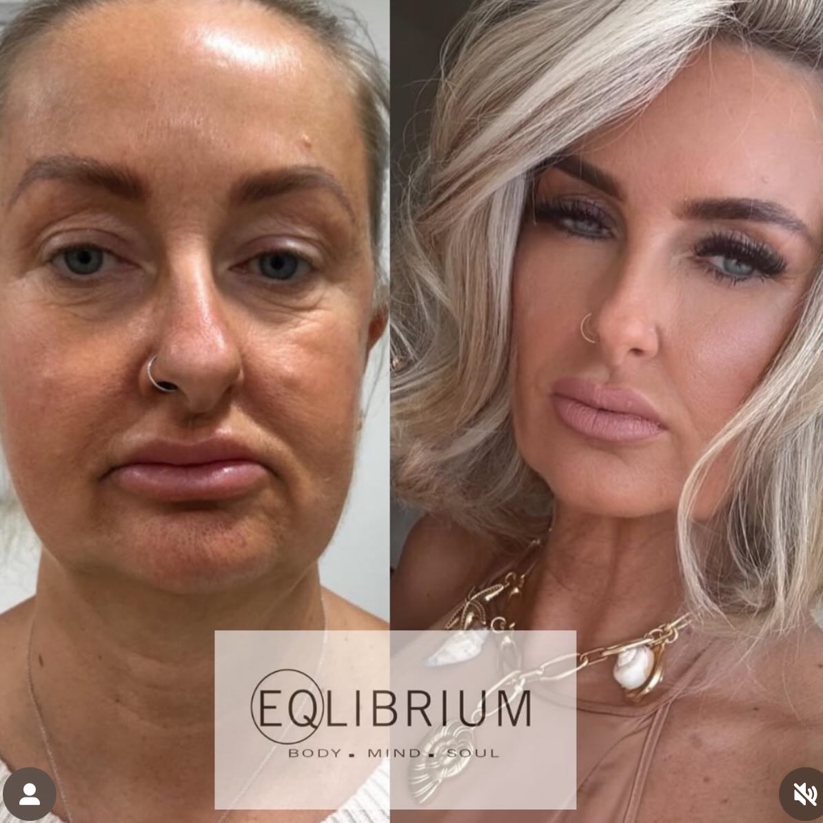 EQ lift before and after Lower face & jawline definition