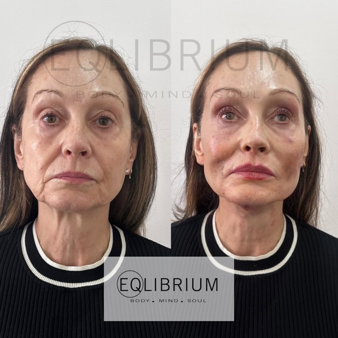 EQ lift before and after Cheek fat pad repositioning & jowls