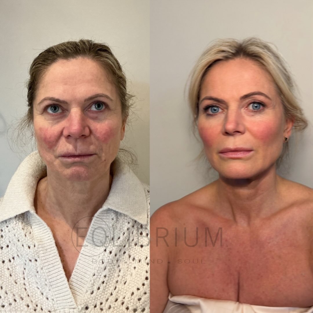 EQ lift before and after Full facial lift & under-eye rejuvenation