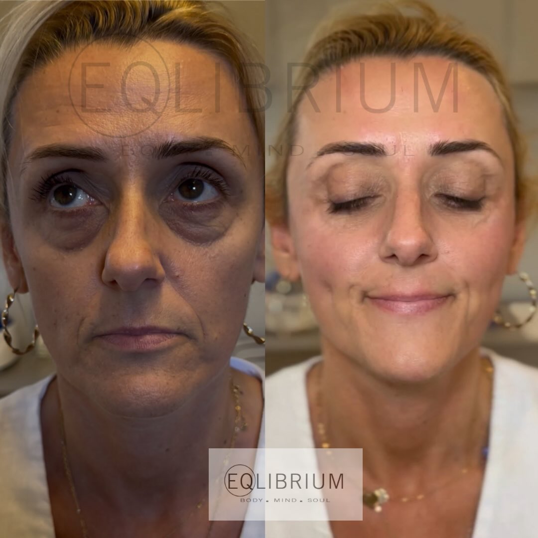 EQ lift before and after Under-eye & mid-face repositioning
