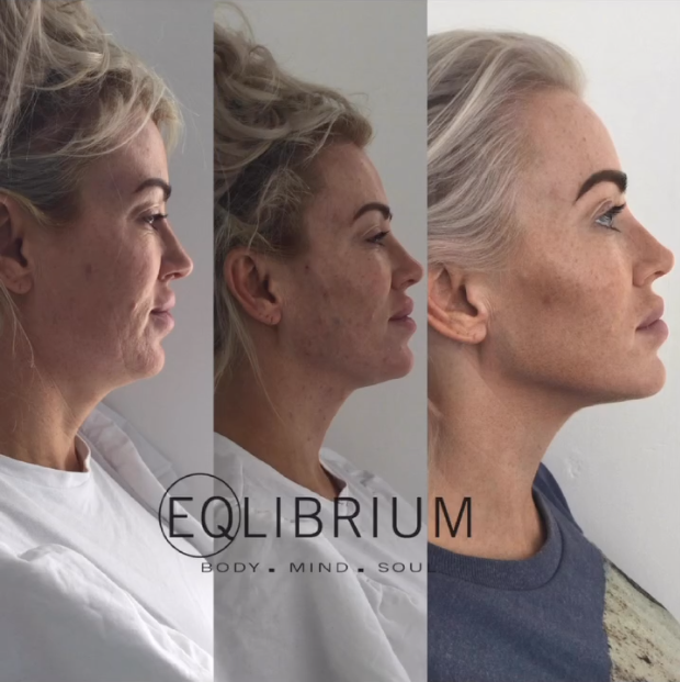EQ lift before and after Jawline, neck & lower face profile
