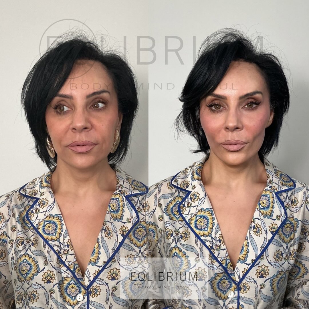 EQ lift before and after Mid-face lift & cheekbone contour