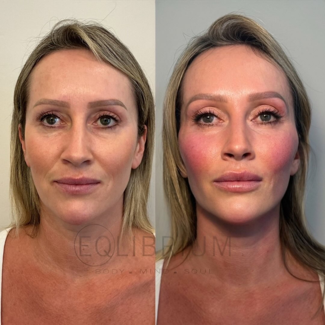 EQ lift before and after Full facial lift & cheek contour
