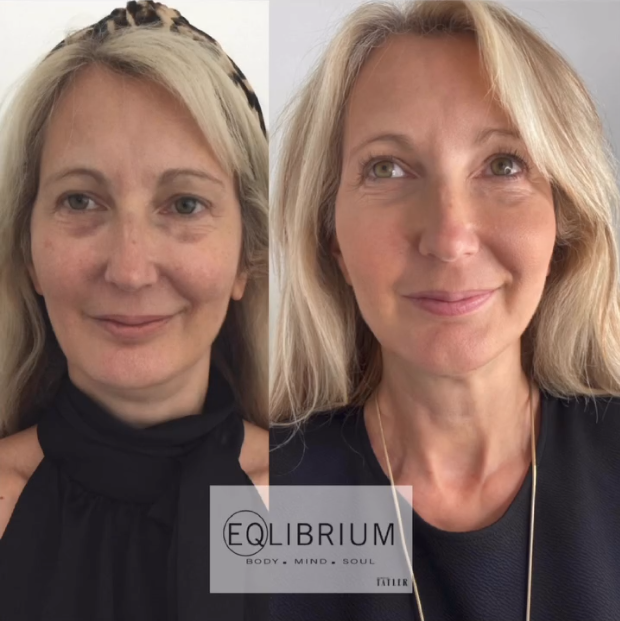EQ lift before and after Under-eye rejuvenation & mid-face lift