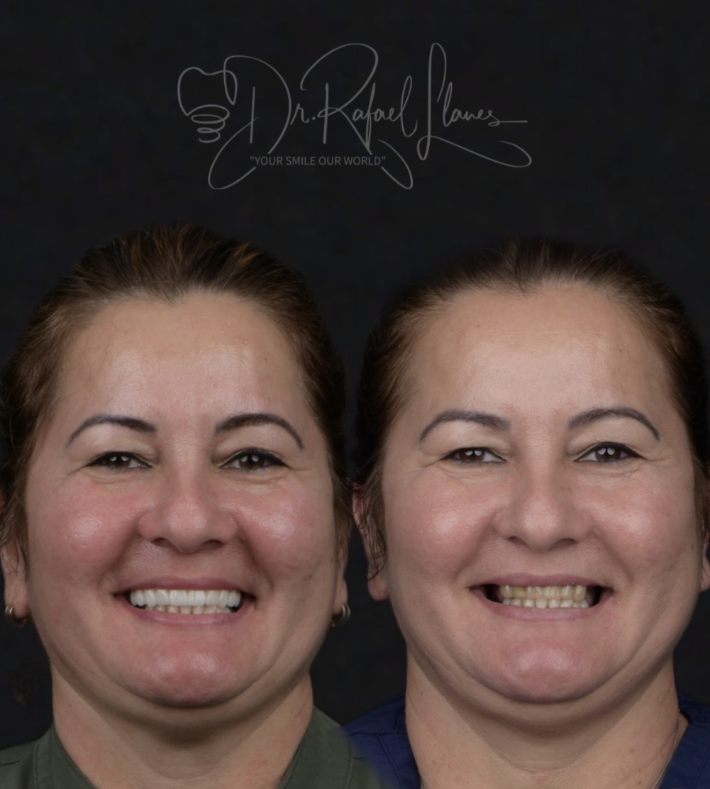 Before and after comprehensive restoration by Dr. Rafael Llanes - Case 3