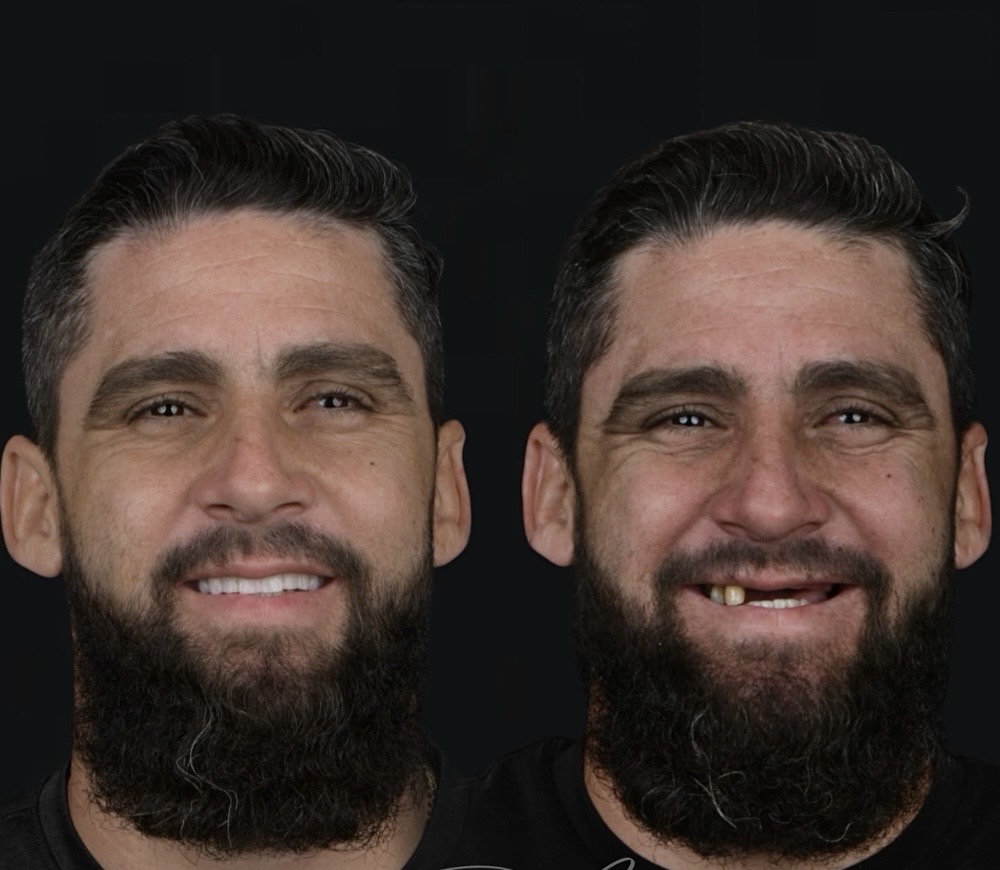 Before and after All-On-X complete rehabilitation by Dr. Rafael Llanes - Case 1
