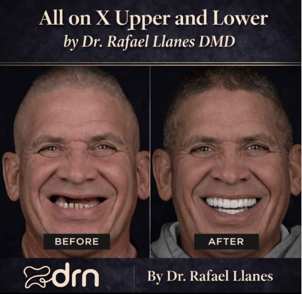 All on X Upper and Lower by Dr. Rafael Llanes DMD - Case 2