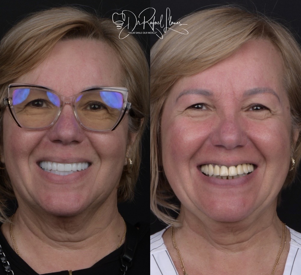 Before and after facial transformation and smile by Dr. Rafael Llanes - Case 4