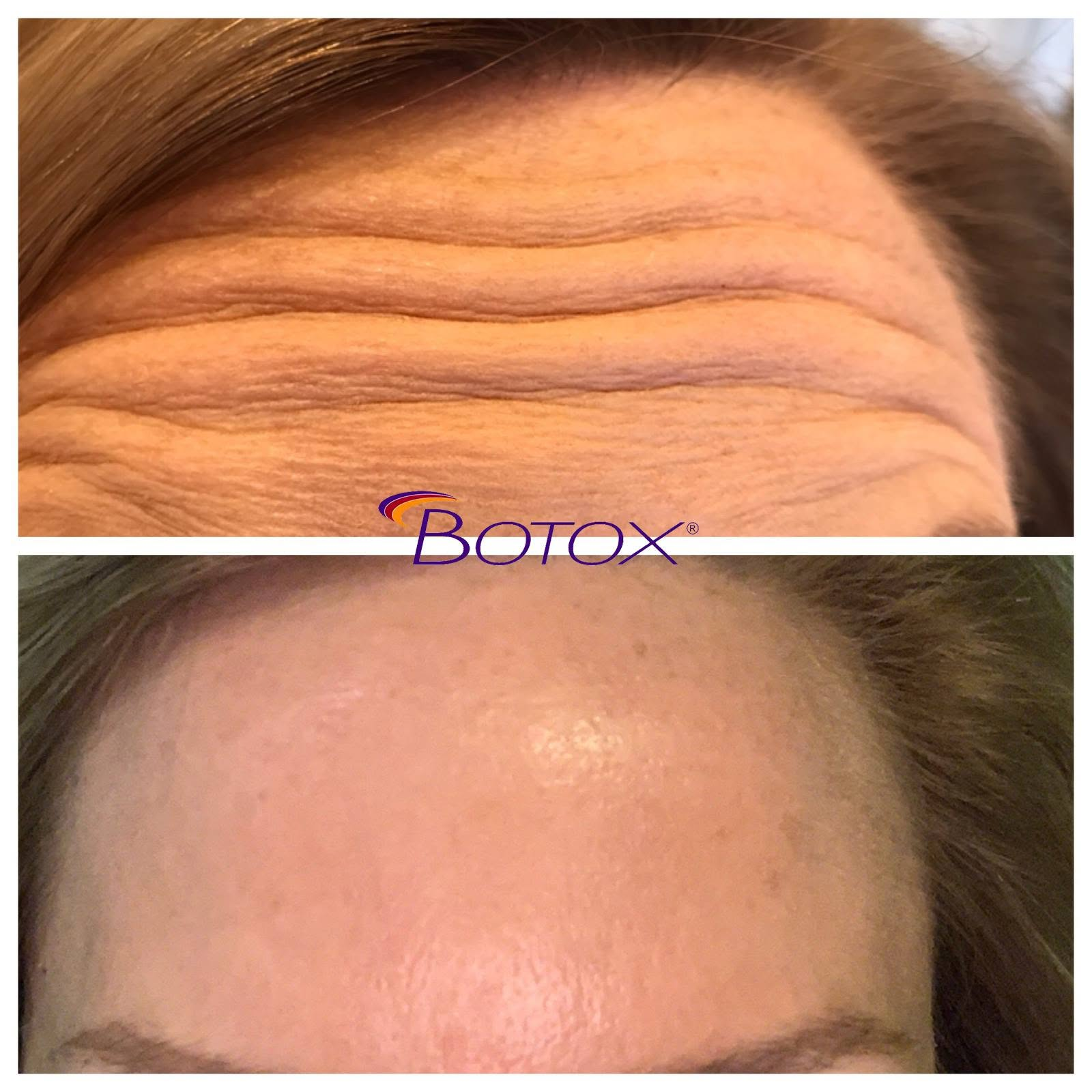 Authentic Coker Dentistry Botox Cosmetic deep forehead line smoothing before and after