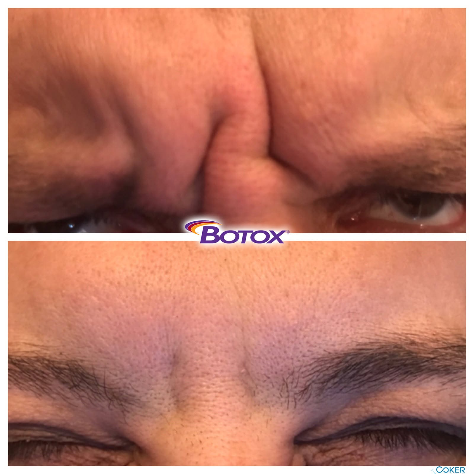Botox Cosmetic wrinkle smoothing at Coker Dentistry in Florence, Alabama