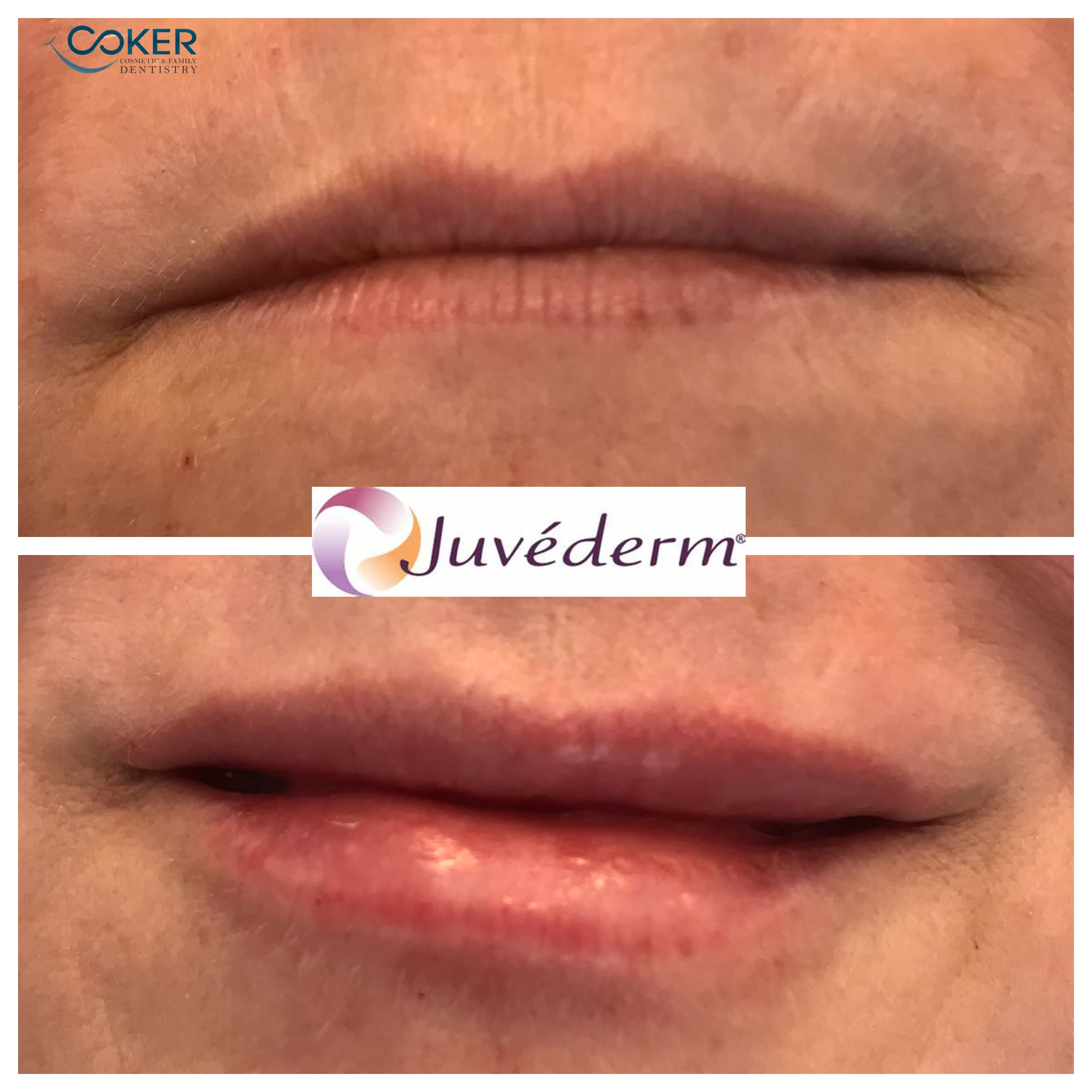 Official Coker Cosmetic Dentistry Juvederm lip restoration before and after