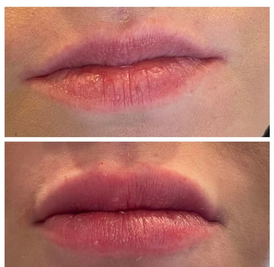 Juvederm dermal filler lip and facial contouring at Coker Dentistry in Florence, Alabama