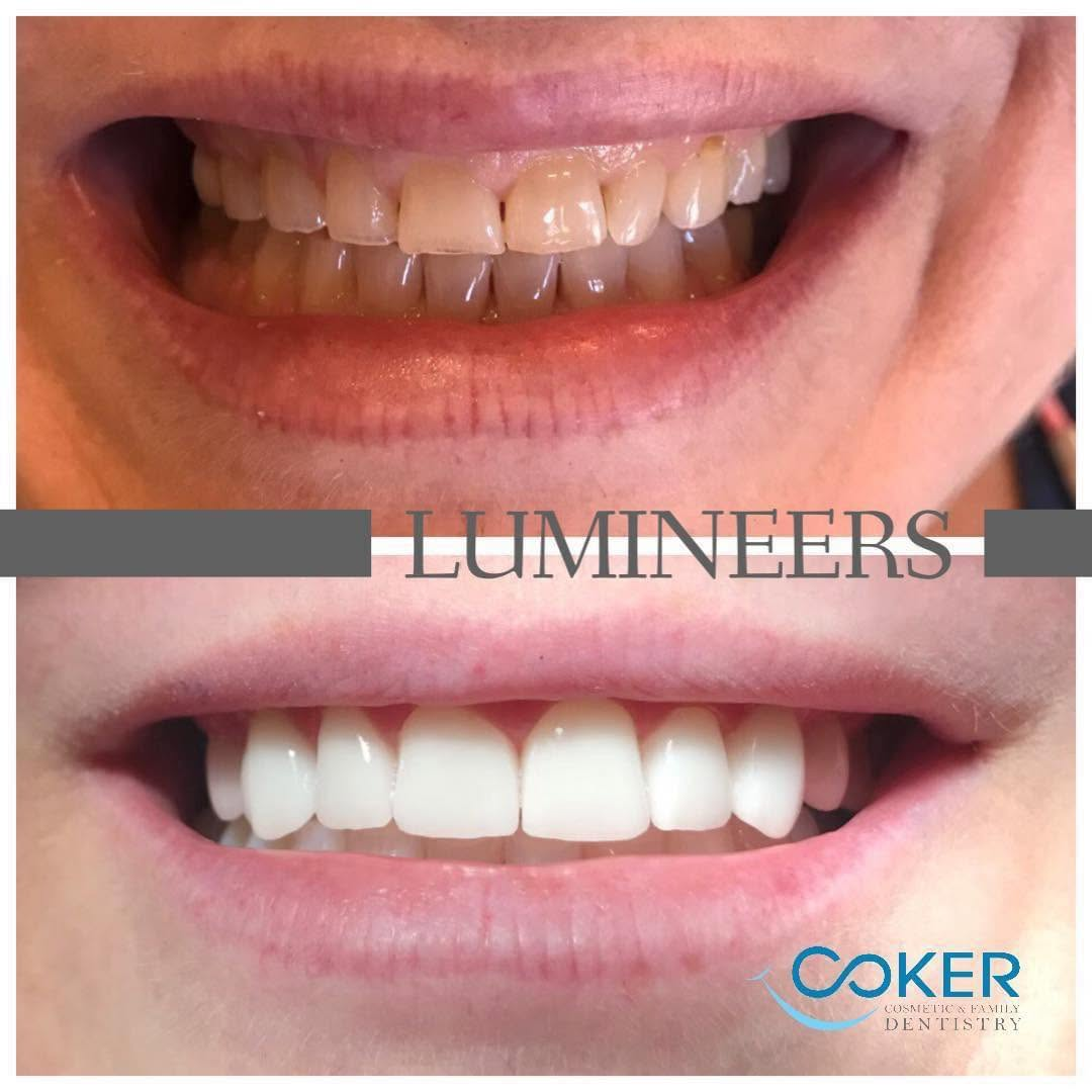 Authentic Lumineers veneer smile makeover before and after by Coker Cosmetic & Family Dentistry in Florence, Alabama