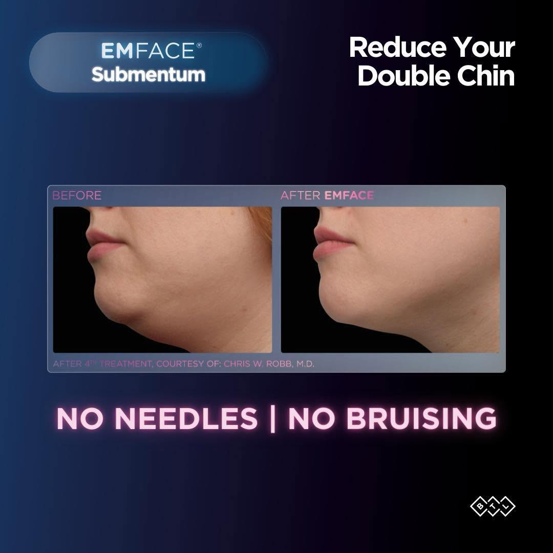 EMFACE non-surgical facial lift at Coker Dentistry in Florence, Alabama