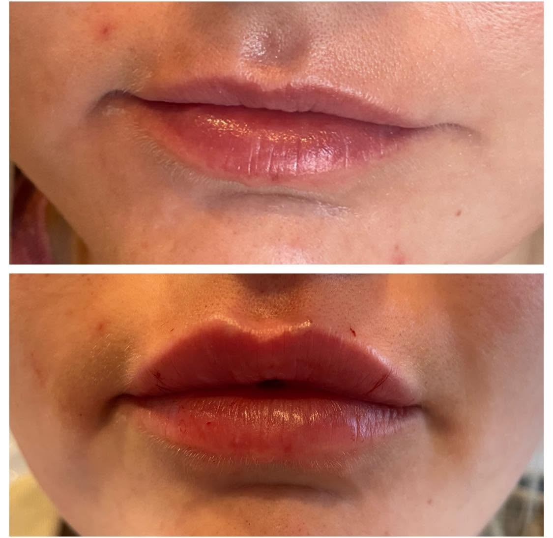 Facial aesthetic and smile harmony treatment at Coker Dentistry in Florence, Alabama