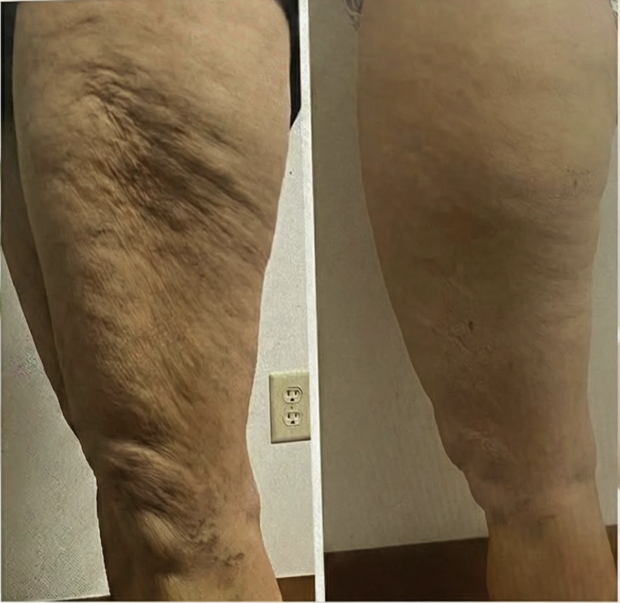 Authentic Body Lyft System thigh cellulite and skin appearance before and after result