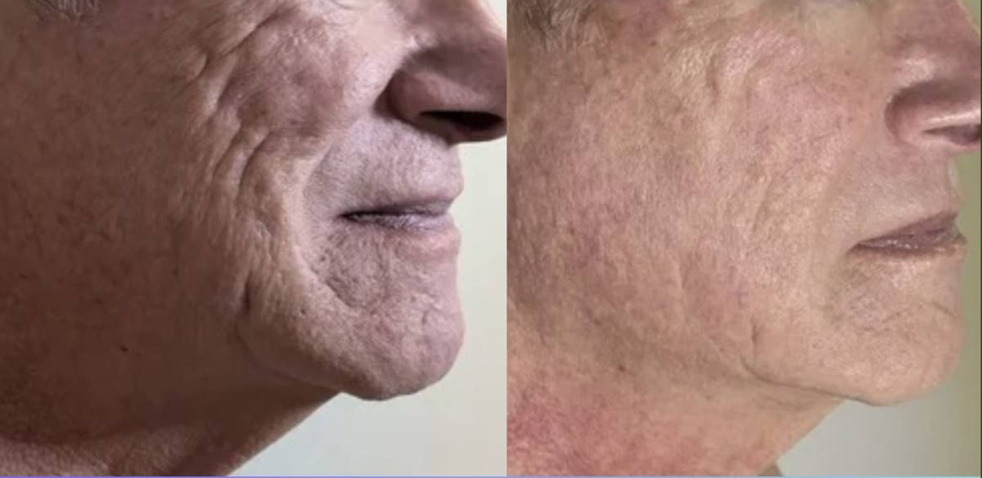 Authentic Body Lyft System facial rejuvenation and skin tightening before and after result