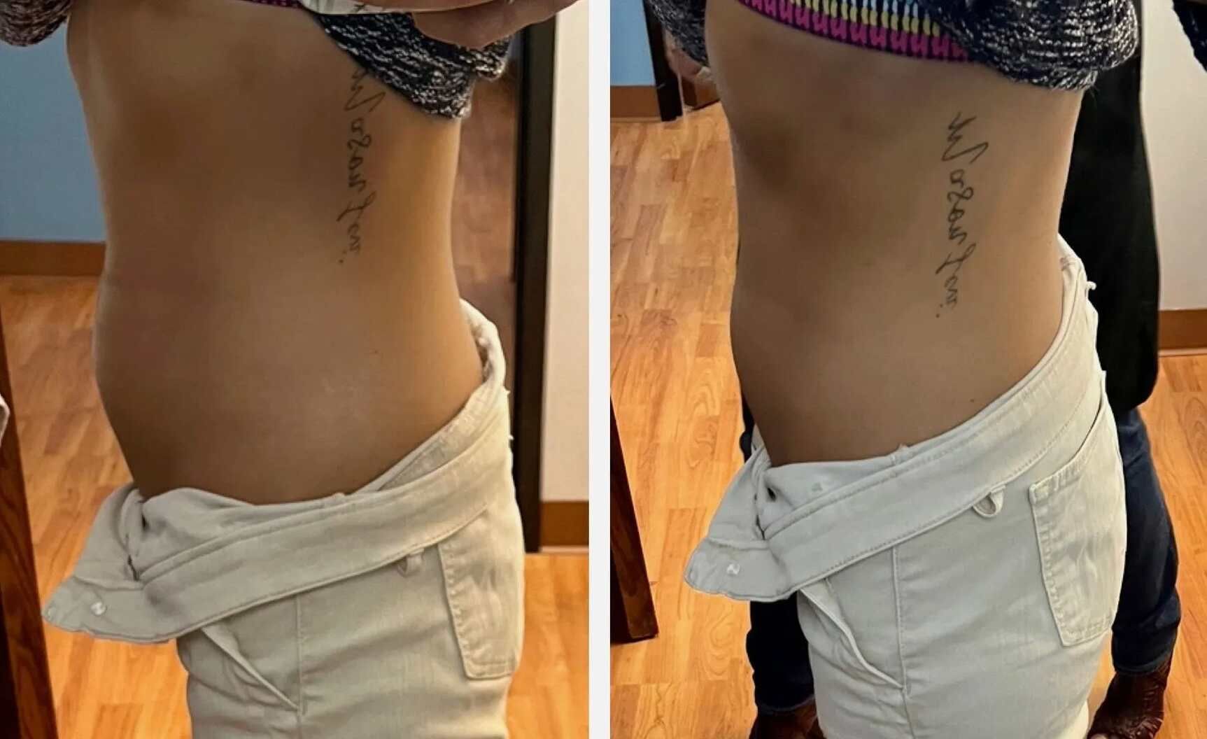 Authentic Body Lyft System waist body contouring before and after client result