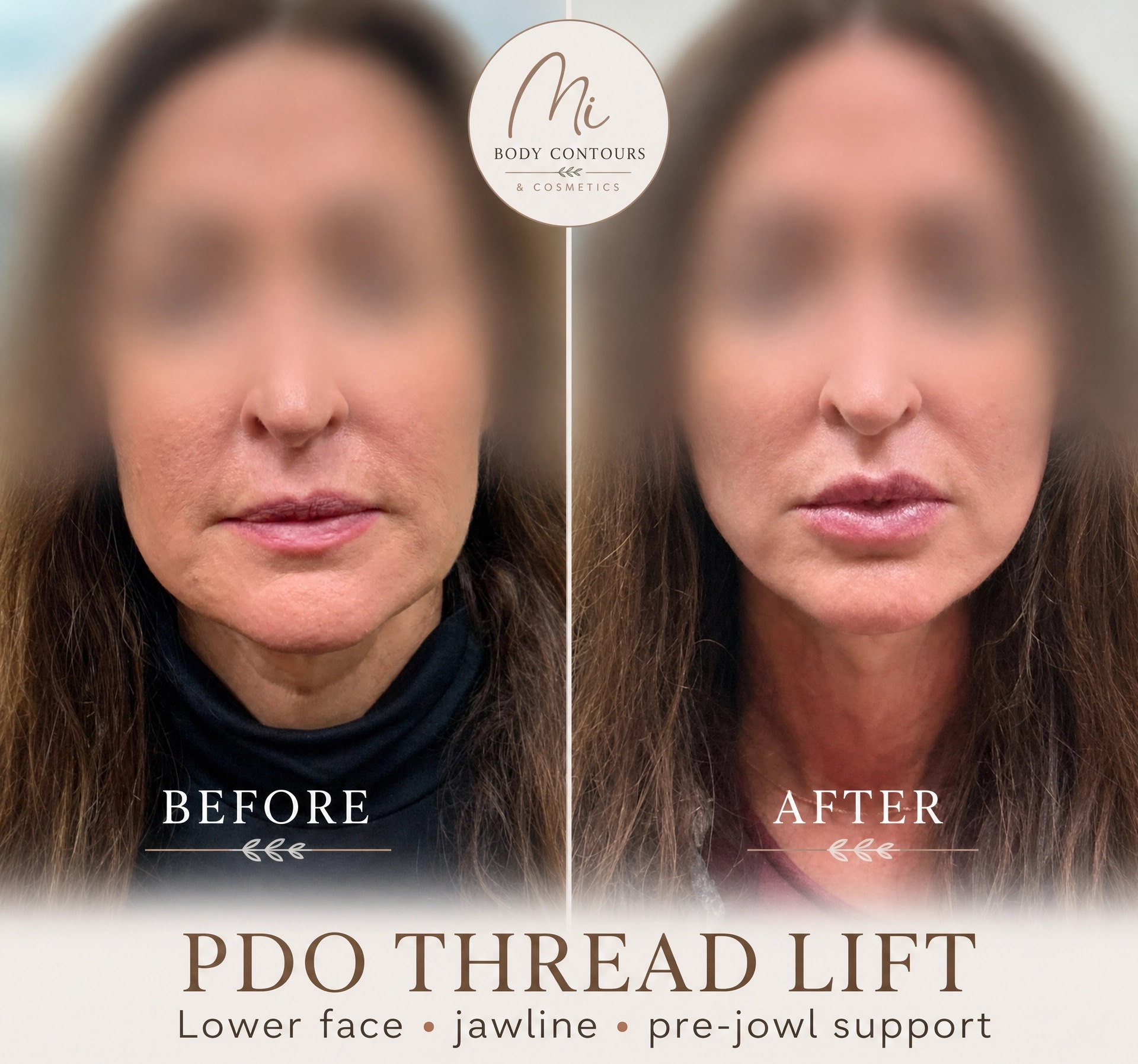 Before and after PDO thread lift comparison showing lower face, jawline and pre-jowl support
