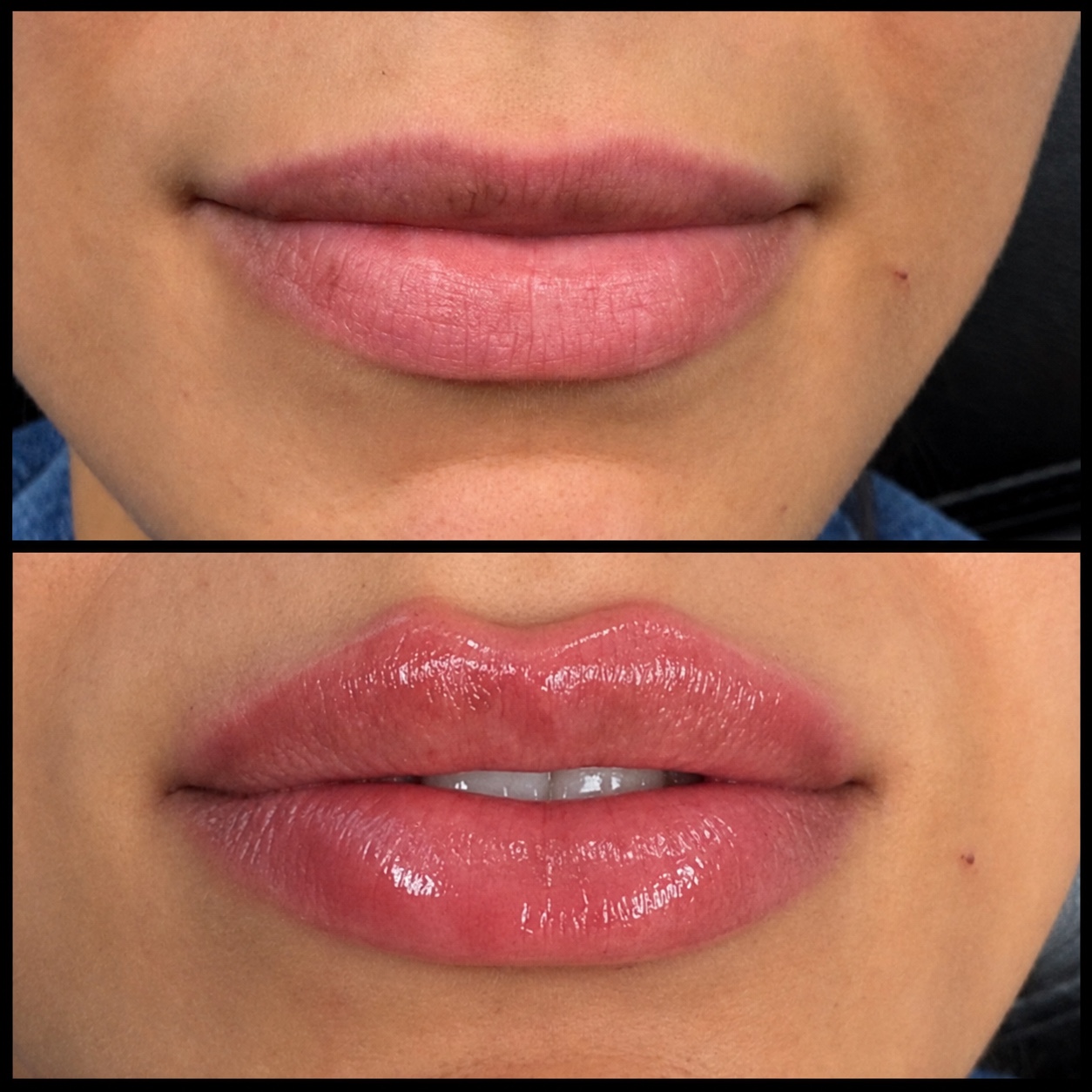 Lip filler before and after — real MI Body Contours patient. Individual results vary.