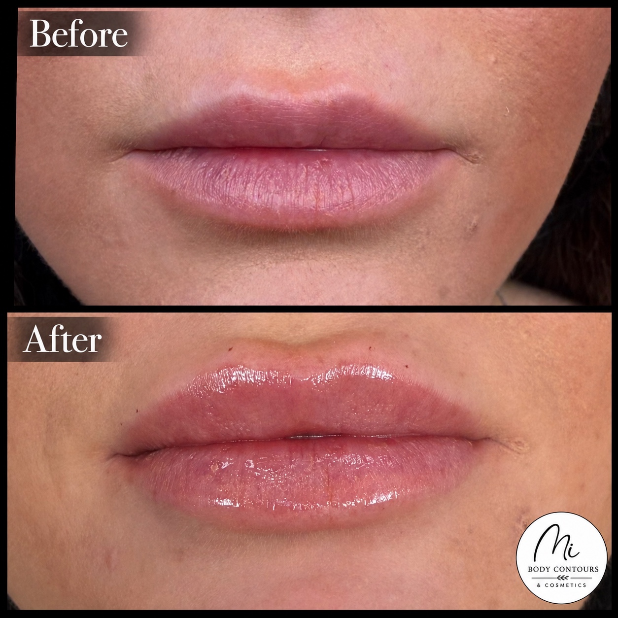 Lip filler before and after — real MI Body Contours patient. Individual results vary.